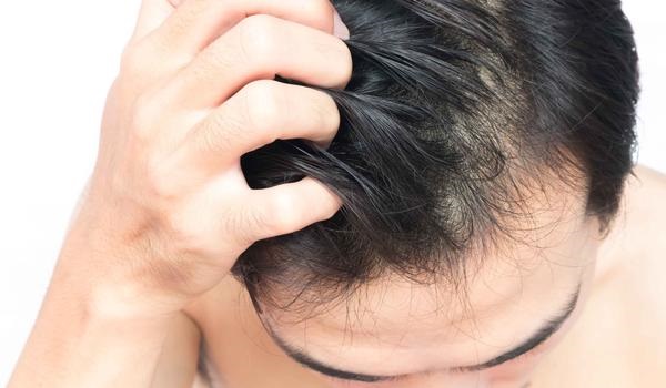 掉头发原因与护理都有那些</